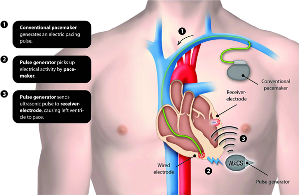 Wireless Cardiac Stimulation System